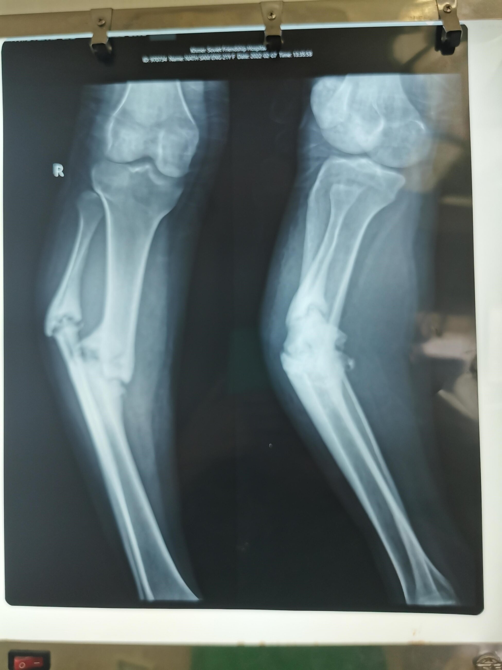A young lady had been walking on this fracture for a couple of months
