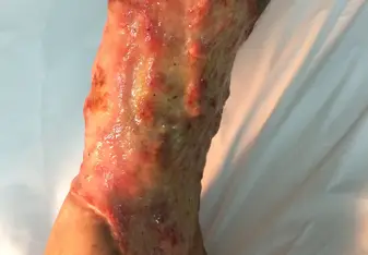 Patient wound