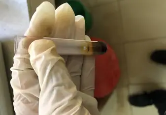 Blood sample after having been in the centrifuge