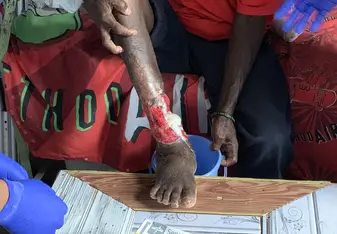 Leprosy wound that we dressed