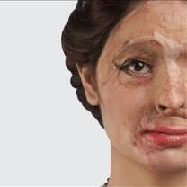 Acid Attack Survivor