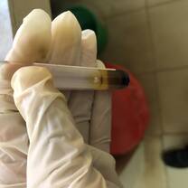 Blood sample after having been in the centrifuge