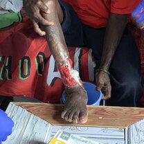 Leprosy Wound Leprosy wound that we dressed