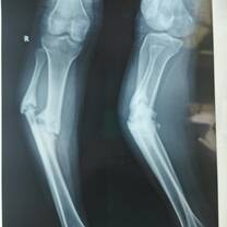 A young lady had been walking on this fracture for a couple of months